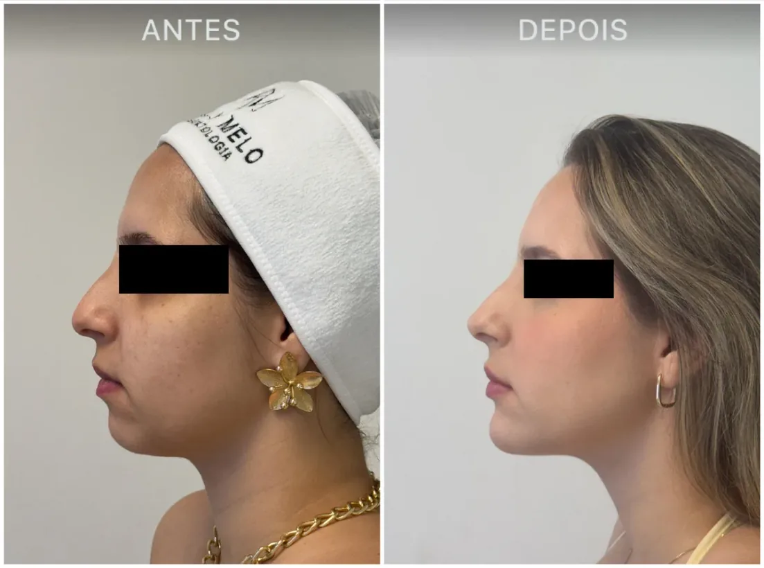 Caso real de tratamento com a Dra. Kelly Melo, antes e depois (1 de 8)