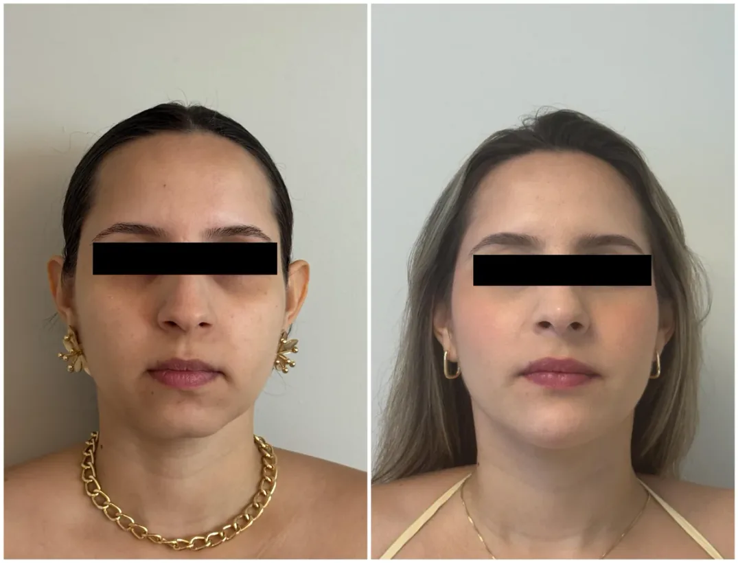 Caso real de tratamento com a Dra. Kelly Melo, antes e depois (2 de 8)