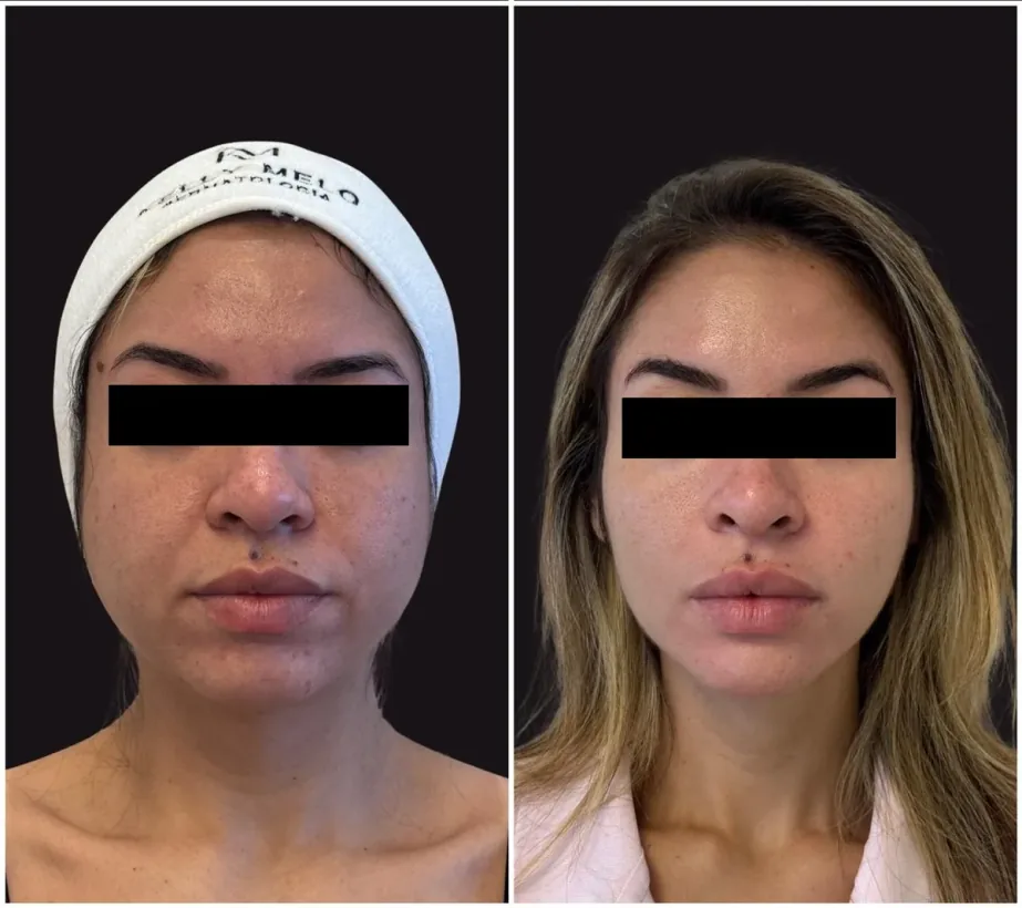 Caso real de tratamento com a Dra. Kelly Melo, antes e depois (3 de 8)