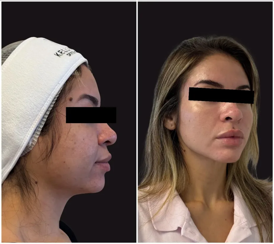Caso real de tratamento com a Dra. Kelly Melo, antes e depois (4 de 8)