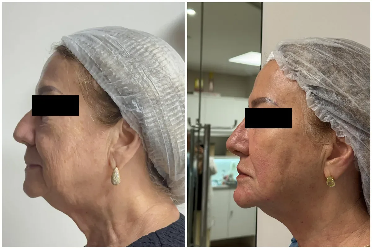 Caso real de tratamento com a Dra. Kelly Melo, antes e depois (5 de 8)